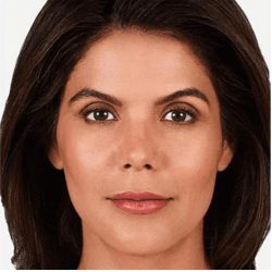 JUVÉDERM® VOLUMA® XC Before & After Patient #1653